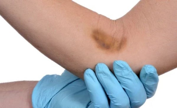 Trong vài trường hợp hiếm hoi xét nghiệm máu có thể để lại vết bầm