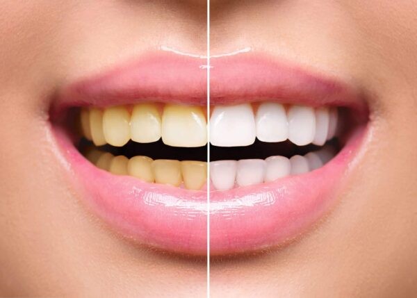 Thuốc Medoral có thể gây đổi màu răng