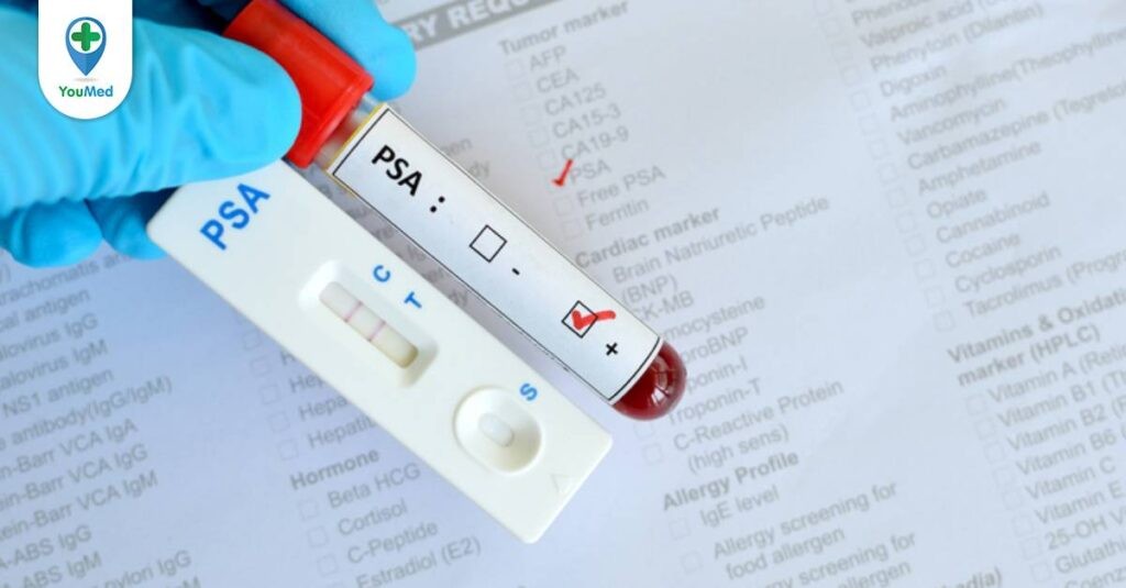 Xét nghiệm PSA là gì? Ý nghĩa của xét nghiệm PSA trong tầm soát ung thư tuyến tiền liệt