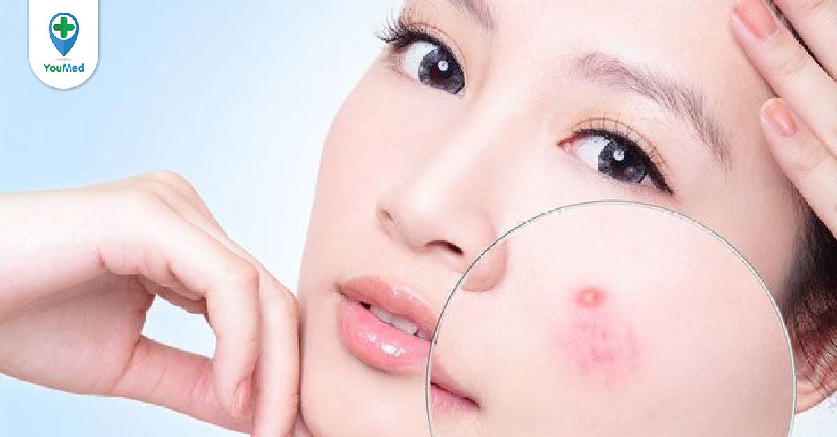 Kem trị mụn Neutrogena On-The-Spot Acne Treatment có tác dụng trong trường hợp nào không nên sử dụng?
