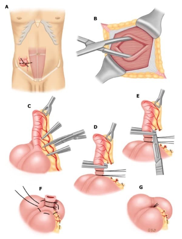 Mô tả phương pháp phẫu thuật cắt ruột thừa mổ mở