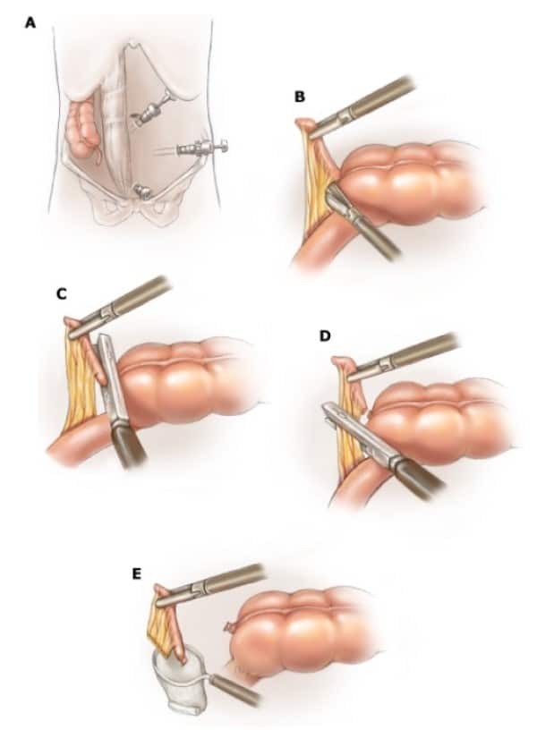 Mô tả phương pháp phẫu thuật cắt ruột thừa bằng nội soi