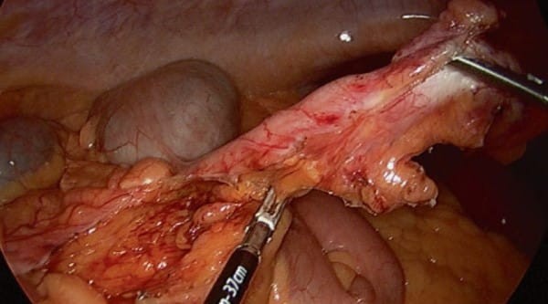 Ruột thừa trong phẫu thuật nội soi cắt ruột thừa
