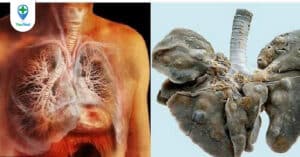 Xét nghiệm sán lá phổi và thông tin về chủng bệnh này