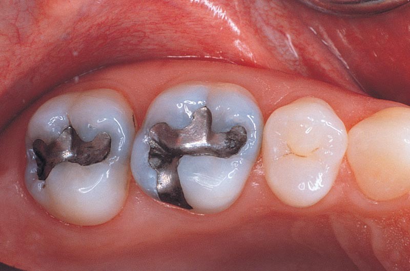 Trám răng bằng vật liệu amalgam
