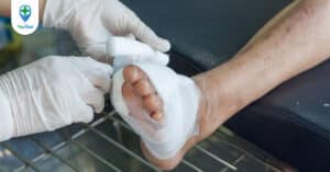Biến chứng tiểu đường gây loét da: triệu chứng và hướng dẫn cách điều trị