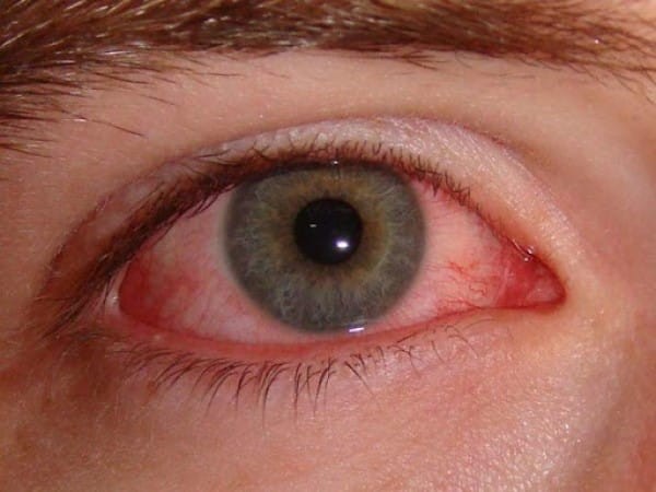 Triệu chứng thường gặp nhất là đỏ mắt, không đau và không giảm thị lực