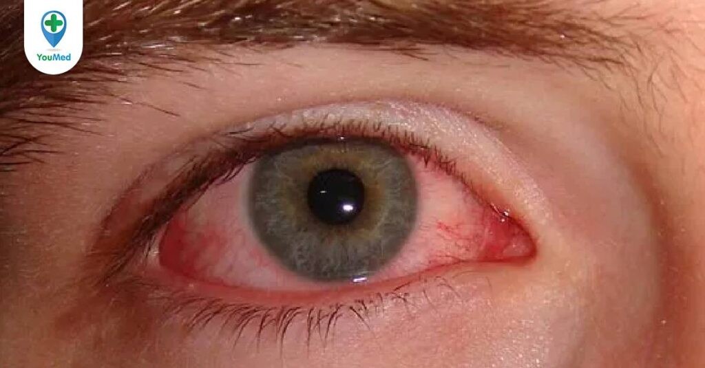 Bệnh đau mắt đỏ: Nguyên nhân, triệu chứng và cách điều trị