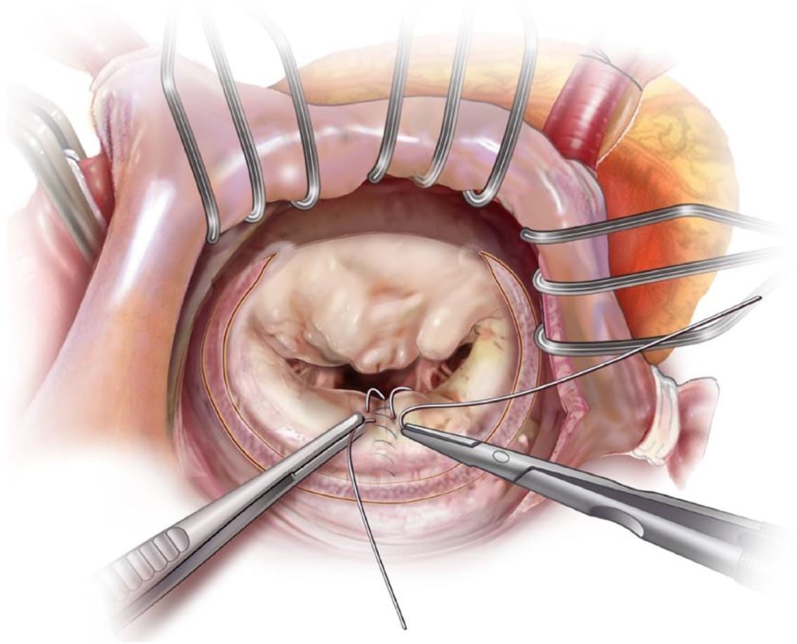 Phẫu thuật sửa van hai lá là một trong những phương pháp điều trị hở van 2 lá trung bình và nặng