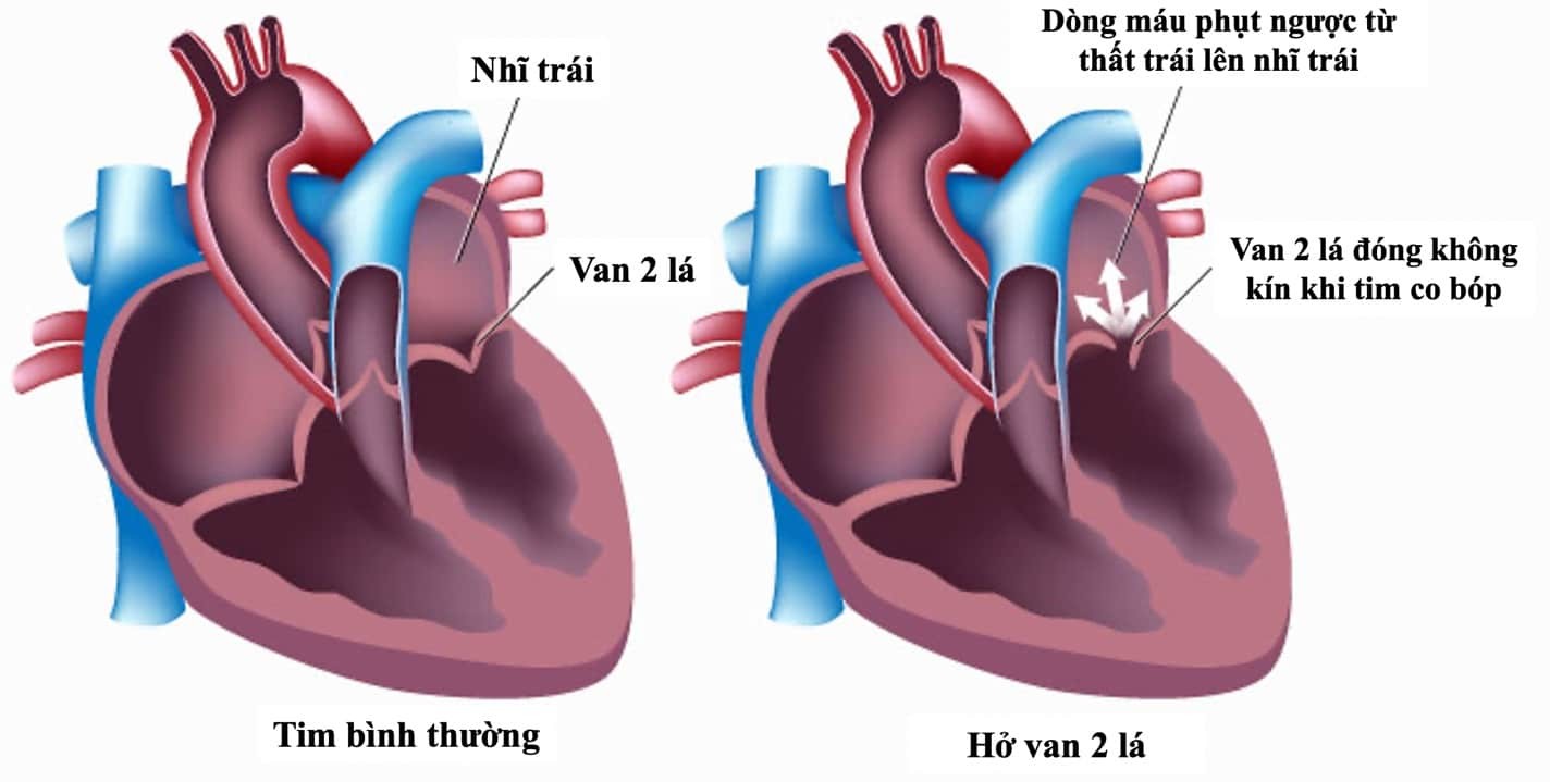 Phân biệt tim bình thường và tim có hở van 2 lá