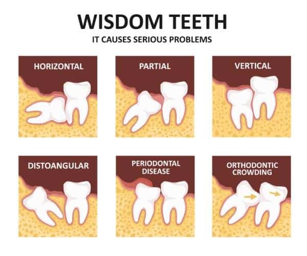 Các hình thái mọc của răng khôn (wisdom teeth) ảnh hưởng đến răng xung quanh