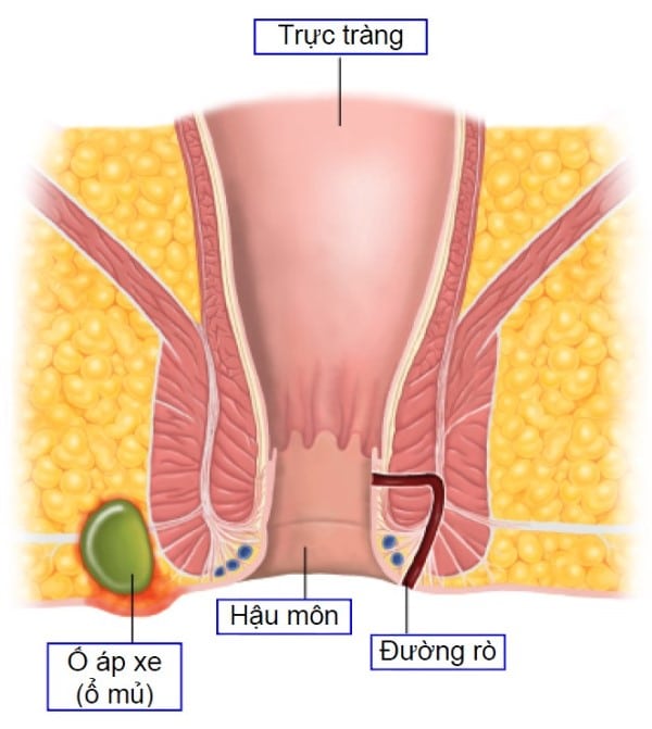 Áp xe hậu môn và rò hậu môn