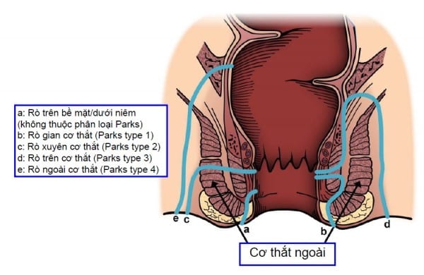 Phân loại rò hậu môn theo Parks và mối liên quan với cơ thắt