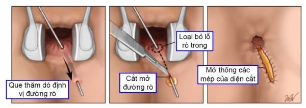 Mô tả phương pháp cắt mở đường rò