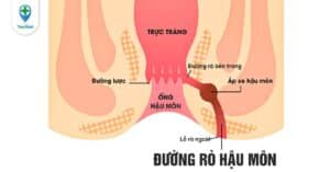 Rò hậu môn: Nguyên nhân, chẩn đoán và điều trị