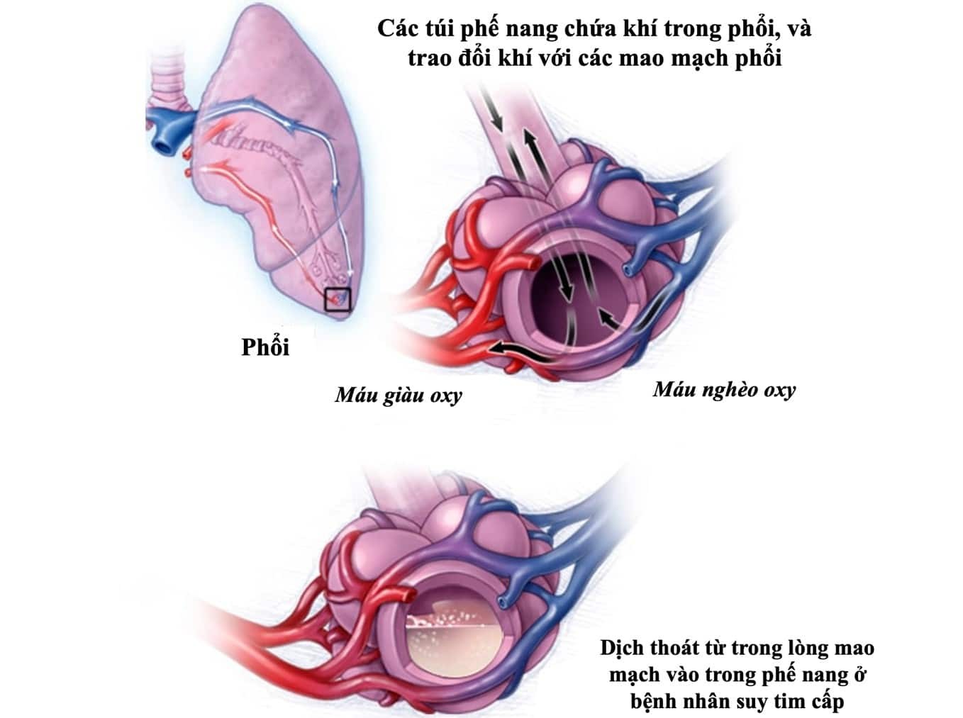 Mô tả tình trạng sung huyết phổi ở bệnh nhân suy tim cấp