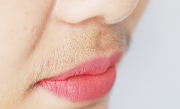 Phụ nữ dư thừa testosterone có thể gặp phải tình trạng rậm lông, râu ở mặt