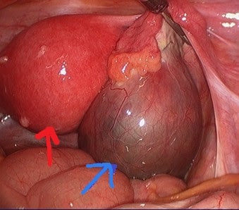 Hình ảnh phẫu thuật nội soi u nang buồng trứng (mũi tên xanh) với tử cung mang thai (mũi tên đỏ)