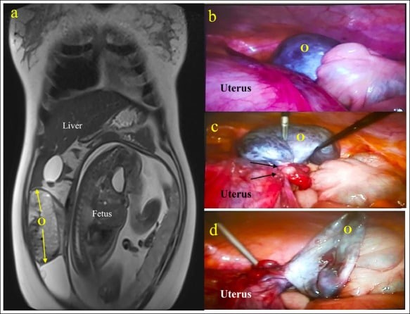 Hình a: hình chụp MRI u buồng trứng và thai; b,c,d: phẫu thuật nội soi u buồng trứng có biến chứng xoắn. O: buồng trứng, Fetus: thai nhi, Uterus: tử cung mang thai