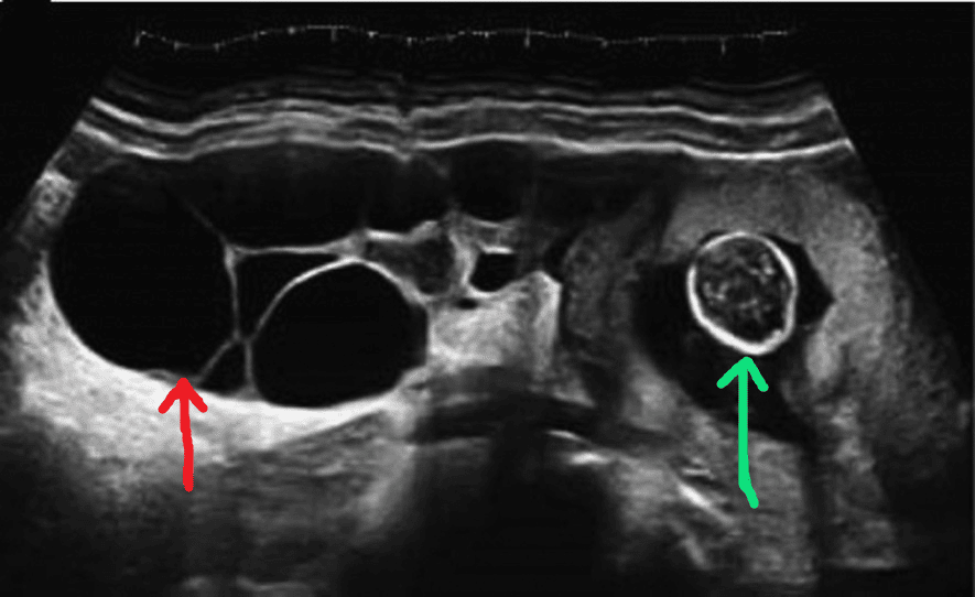 Hình ảnh siêu âm cho thấy khối u buồng trứng (mũi tên đỏ) và thai nhi trong tử cung (mũi tên xanh)