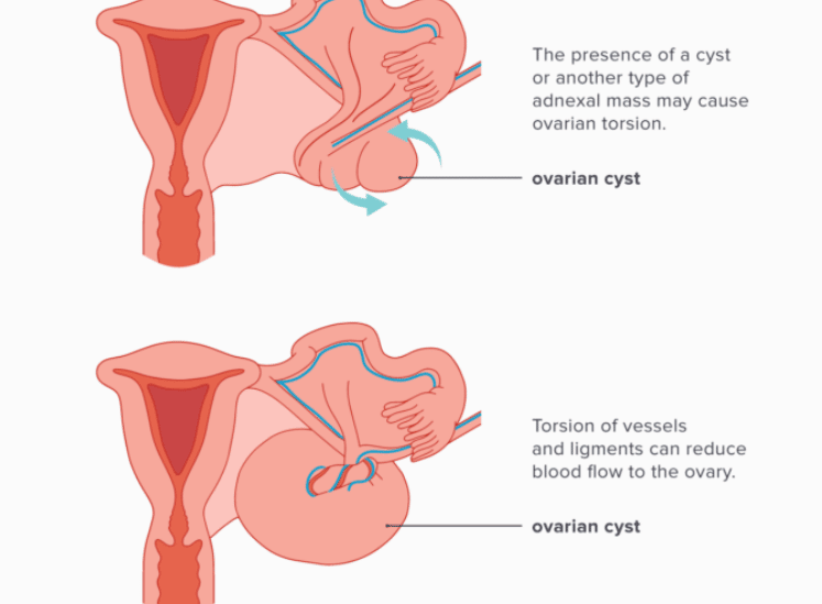 Cơ chế gây xoắn buồng trứng của khối u
