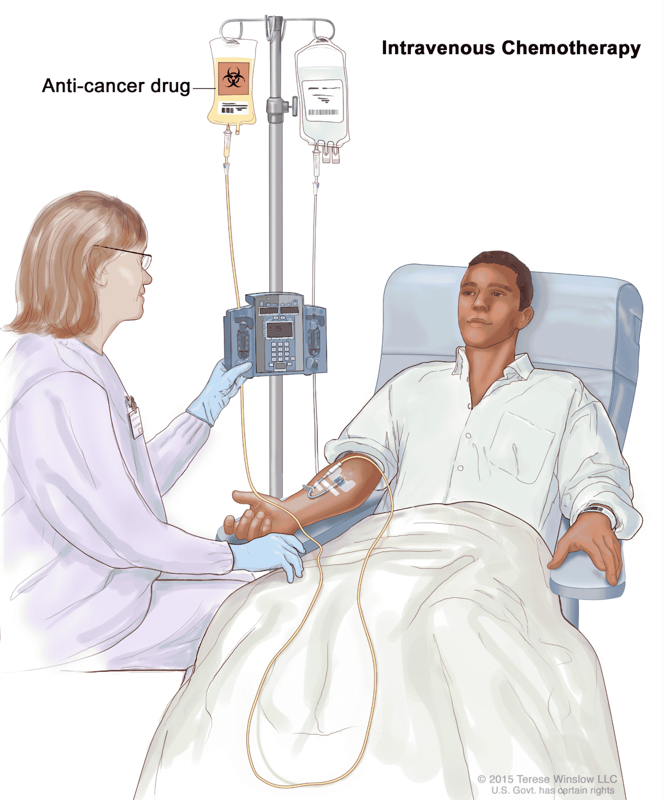 Bệnh nhân đang được truyền hóa chất liên tục qua đường tĩnh mạch
