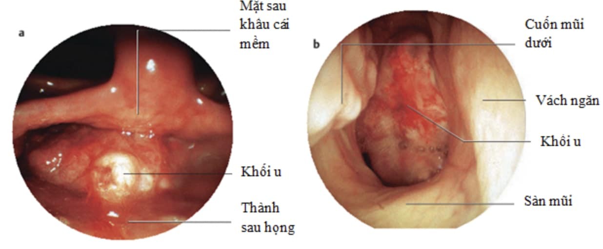 Hình ảnh Ung thư vòm họng qua nội soi