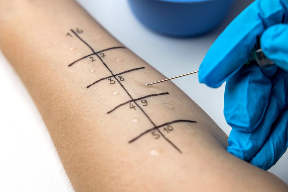 Nguyên tắc của test lẩy da là kích hoạt kháng thể IgE trên tế bào mast của da