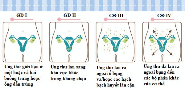 Ung thư buồng trứng được chia thành 4 giai đoạn