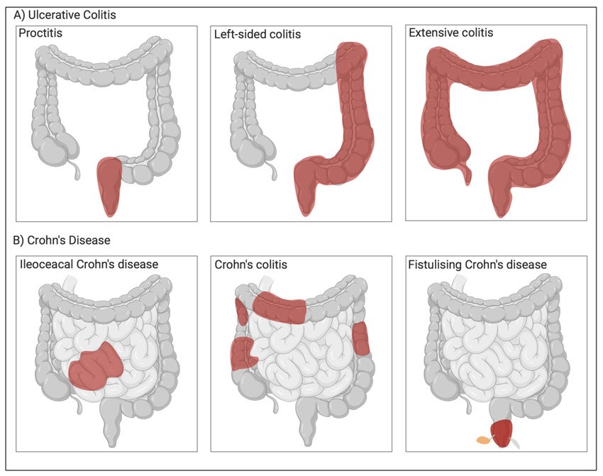 Các dạng tổn thương chính của viêm loét đại tràng và bệnh Crohn