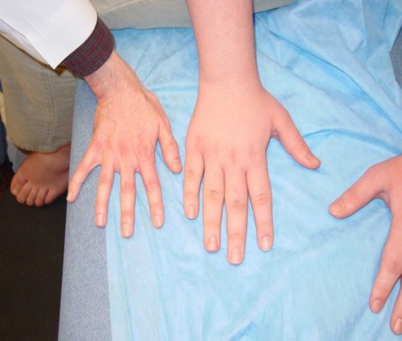 Hình ảnh bàn tay lớn bất thường ở trẻ bị bệnh khổng lồ (ở giữa), so với bàn tay của một người đàn ông trưởng thành cao 185 cm (bên trái bức ảnh). Đường kính ngón giữa của bàn tay đứa trẻ này lên đến 9 cm