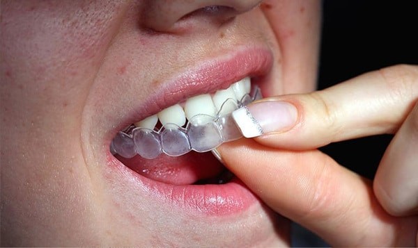 Mang dụng cụ bảo vệ răng này trước khi ngủ có thể giúp không nghiến răng một cách vô thức