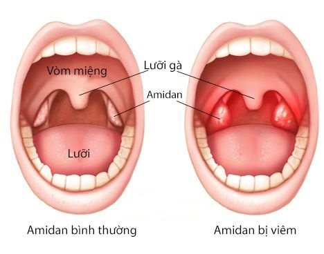 Những triệu chứng viêm amidan và cách điều trị - YouMed