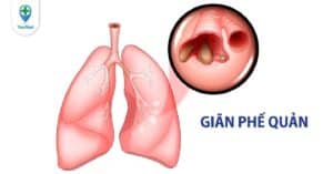 Sử dụng vật lý trị liệu trong điều trị giãn phế quản