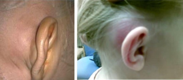 Triệu chứng sưng đau sau tai trong biến chứng viêm xương chũm cấp