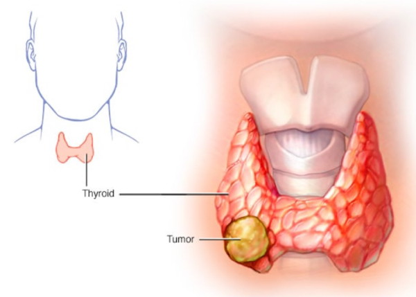 Ung thư tuyến giáp