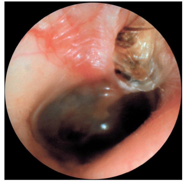 Cholesteatoma nguyên phát ở phần thượng nhĩ, phần màng chùng của màng nhĩ (Chronic Otitis Media, Mastoiditis, and Petrositis - Cummings Otolaryngology _ Head and Neck Surgery 7th)