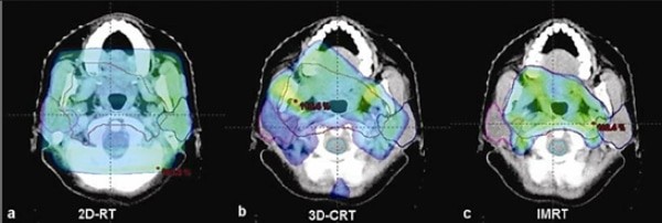 Hình: Xạ trị vùng đầu cổ bằng kỹ thuật 2D (a), 3D (b) và IMRT (c)