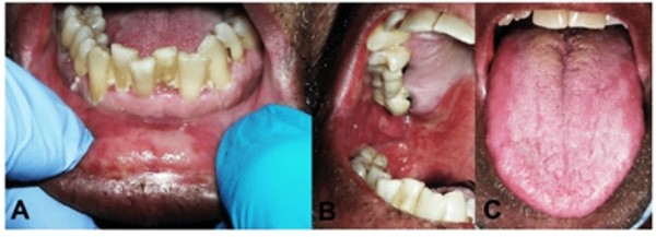 Hình: Viêm loét niêm mạc miệng do hóa trị