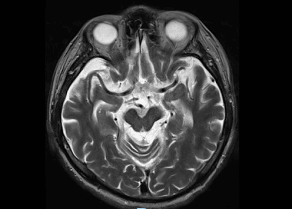 Hình ảnh MRI não