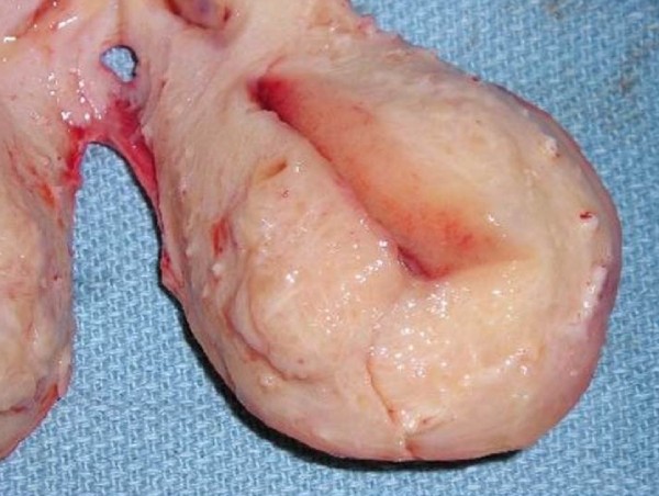 Hình ảnh tử cung đã cắt có bị adnemyosis