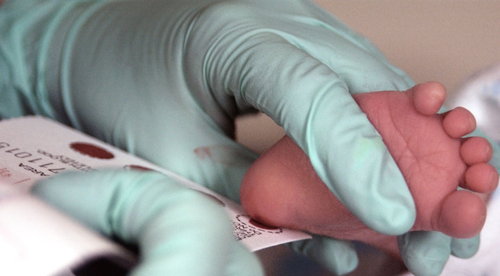 Lấy máu gót chân ở trẻ sơ sinh để làm xét nghiệm tầm soát tăng sản thượng thận bẩm sinh