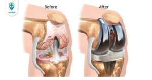 Thay khớp gối là gì? Chỉ định, quy trình thực hiện và những lưu ý