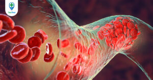 Thuyên tắc huyết khối tĩnh mạch: Nguyên nhân và cách điều trị