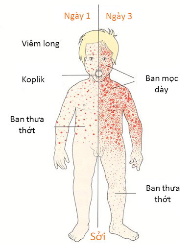 Trình tự triệu chứng bệnh sởi