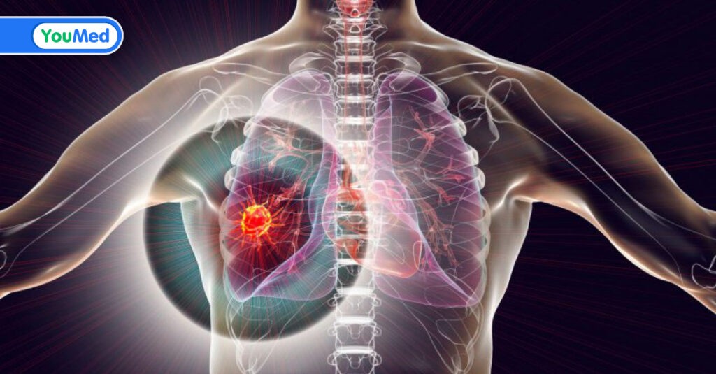 Ung thư biểu mô tuyến phổi: dấu hiệu, chẩn đoán và cách điều trị