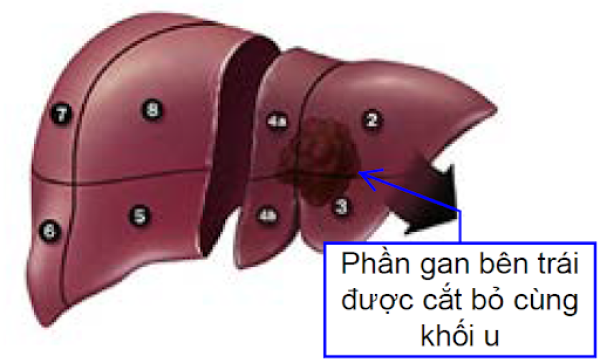 Mô tả đơn giản phương pháp cắt gan kèm khối u