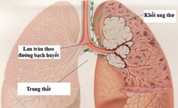 Tế bào ung thư lan tràn theo đường bạch huyết đến hạch trung thất