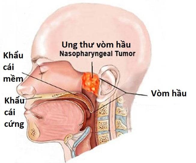 Hình ảnh giải phẫu ung thư vòm họng.