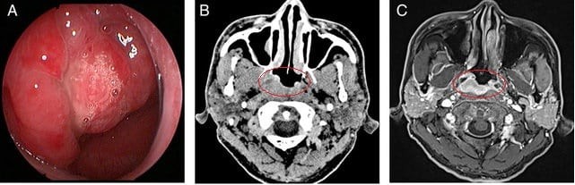 Hình: ung thư vòm họng quan sát trên cùng một bệnh nhân: A. Nội soi tai mũi họng, B. Chụp cắt lớp vi tính (CT) đầu cổ, C. Chụp cộng hưởng từ (MRI) đầu cổ.